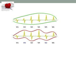 V1V1 V6V6
Morphologie habituelle
des QRS précordiaux
Croissance harmonieuse de R de V1 à V4
 