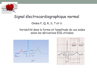 Signal électrocardiographique normal
Ondes P, Q, R, S, T et U
Variabilité dans la forme et l’amplitude de ces ondes
selon les dérivations ECG utilisées
 