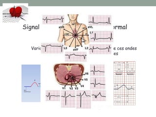 Signal électrocardiographique normal
Ondes P, Q, R, S, T et U
Variabilité dans la forme et l’amplitude de ces ondes
selon les dérivations ECG utilisées
 