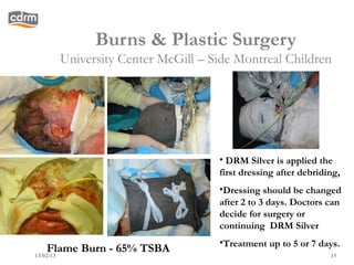Burns & Plastic Surgery
    University Center McGill – Side Montreal Children




                                • DRM Silver is applied the
                                first dressing after debriding,
                                •Dressing should be changed
                                after 2 to 3 days. Doctors can
                                decide for surgery or
                                continuing DRM Silver
                                •Treatment up to 5 or 7 days.
    Flame Burn - 65% TSBA
13/02/13                                                    15
 