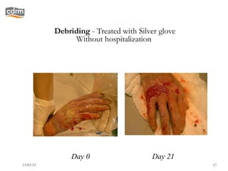 Debriding - Treated with Silver glove
                Without hospitalization




                Day 0                   Day 21
13/02/13                                           17
 