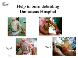 Help in burn debriding
             Damascus Hospital




Day 0                     Day 5


 13/02/13                            18
 