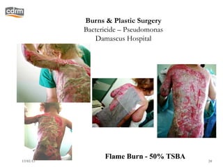 Burns & Plastic Surgery
           Bactericide – Pseudomonas
              Damascus Hospital




13/02/13
                 Flame Burn - 50% TSBA   20
 