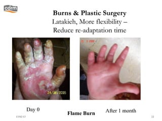 Burns & Plastic Surgery
                   Latakieh, More flexibility –
                   Reduce re-adaptation time




           Day 0                      After 1 month
13/02/13
                        Flame Burn                    22
 