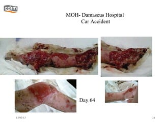 MOH- Damascus Hospital
                Car Accident




                Day 64


13/02/13                            24
 