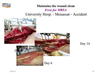 Maintains the wound clean
                         Even for MRSA
              University Hosp. - Mouassat - Accident




                                                Day 14

      Day 0


                         Day 6

13/02/13                                                 25
 