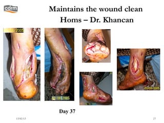 Maintains the wound clean
             Homs – Dr. Khancan




             Day 37
13/02/13                               27
 