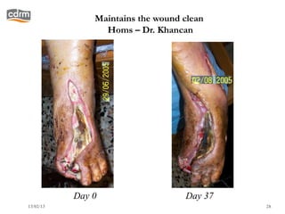 Maintains the wound clean
                 Homs – Dr. Khancan




           Day 0                   Day 37
13/02/13                                    28
 