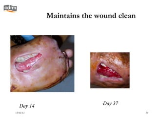 Maintains the wound clean




   Day 14                  Day 37
13/02/13                                30
 