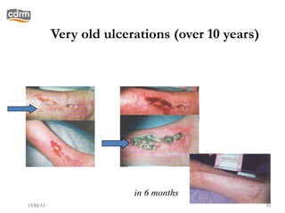 Very old ulcerations (over 10 years)




                         in 6 months
13/02/13                                          31
 