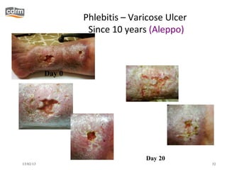 Phlebitis – Varicose Ulcer
                    Since 10 years (Aleppo)



           Day 0




                                  Day 20
13/02/13                                        32
 