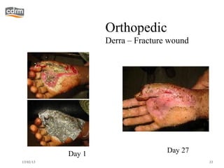 Orthopedic
                   Derra – Fracture wound




           Day 1                   Day 27
13/02/13                                    33
 