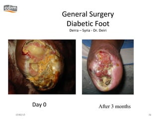 General Surgery
                    Diabetic Foot
                     Derra – Syria - Dr. Deiri




           Day 0                        After 3 months
13/02/13                                                 34
 