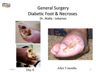General Surgery
            Diabetic Foot & Necroses
                   Dr. Atalla - Lebanon




                                After 5 months
13/02/13
           Day 0                                 35
 