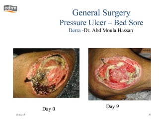 General Surgery
                   Pressure Ulcer – Bed Sore
                     Derra -Dr. Abd Moula Hassan




           Day 0                    Day 9
13/02/13                                           37
 
