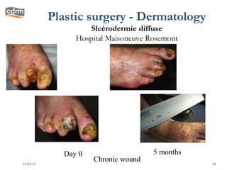 Plastic surgery - Dermatology
                   Slcérodermie diffuse
                Hospital Maisoneuve Rosemont




             Day 0                   5 months
13/02/13
                     Chronic wound              38
 