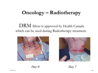 Oncology – Radiotherapy

             DRM Silver is approved by Health Canada
           which can be used during Radiotherapy treatment




                     Day 0                    Day 7
13/02/13                                                     40
 