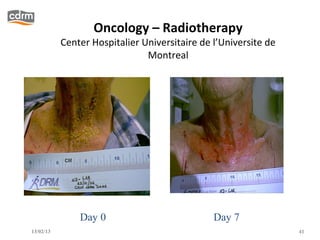 Oncology – Radiotherapy
           Center Hospitalier Universitaire de l’Universite de
                               Montreal




               Day 0                           Day 7
13/02/13                                                         41
 