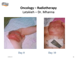Oncology – Radiotherapy
             Latakieh – Dr. Mhanna




           Day 0             Day 10
13/02/13                              42
 