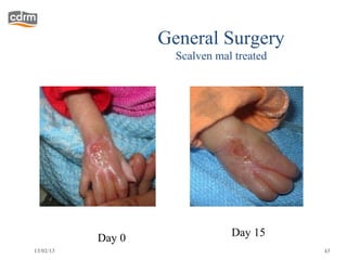 General Surgery
                     Scalven mal treated




           Day 0                Day 15
13/02/13                                   43
 