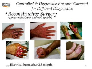 Controlled & Degressive Pressure Garment
             for Different Diagnostics
•Reconstructive Surgery .
   (gloves with zipper and web spacer)




      Electrical burn, after 2.5 months
13/02/13                                  56
 