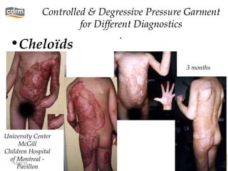 Controlled & Degressive Pressure Garment
                      for Different Diagnostics
                                .
  •Cheloïds
                                             3 months




University Center
      McGill
Children Hospital
  of Montreal -
   13/02/13                                             62
     Pavillon
 