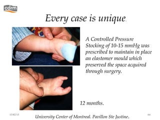 Every case is unique.

                                       A Controlled Pressure
                                       Stocking of 10-15 mmHg was
                                       prescribed to maintain in place
                                       an elastomer mould which
                                       preserved the space acquired
                                       through surgery.




                                    12 months.

13/02/13                                                            64
           University Center of Montreal. Pavillon Ste Justine .
 
