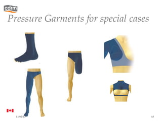 Pressure Garments for special cases




  13/02/13                            65
 