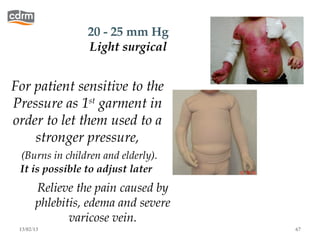 20 - 25 mm Hg
                 Light surgical


For patient sensitive to the
Pressure as 1st garment in
order to let them used to a
    stronger pressure,
 (Burns in children and elderly).
 It is possible to adjust later
       Relieve the pain caused by
       phlebitis, edema and severe
              varicose vein.
 13/02/13                            67
 