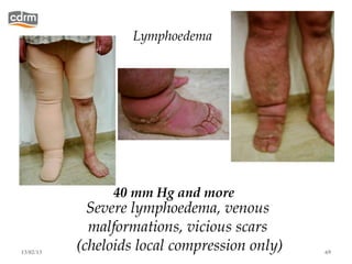 Lymphoedema




                40 mm Hg and more
             Severe lymphoedema, venous
             malformations, vicious scars
13/02/13
           (cheloids local compression only)   69
 
