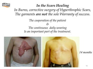 In the Scars Healing
           In Burns, corrective surgery of Hyperthrophic Scars,
            The garments are not the sole Warranty of success.
                     The cooperation of the patient
                                  &
                     The continuous daily wearing
                 Is an important part of the treatment.




                                                          14 months



13/02/13                                                      73
 
