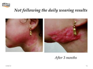 Not following the daily wearing results




                                After 3 months

13/02/13                                         74
 