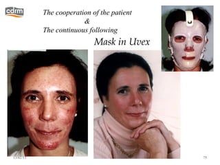 The cooperation of the patient
                        &
           The continuous following
                            Mask in Uvex




13/02/13                                    75
 