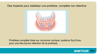 Des implants pour stabiliser une prothèse complète non rétentive




 Prothèse complète fixée sur couronne conique: système SynCone,
 pour une très bonne rétention de la prothèse.
 