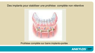 Des implants pour stabiliser une prothèse complète non rétentive




           Prothèse complète sur barre implanto-portée
 