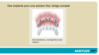 Des implants pour une solution fixe: bridge complet
 