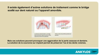Il existe également d’autres solutions de traitement comme le bridge
scellé sur dent naturel ou l’appareil amovible.




Mais ces solutions peuvent provoquer une aggravation de la perte osseuse et dentaire.
La solution de la couronne sur implant permet de préserver l’os et les dents voisines.
 