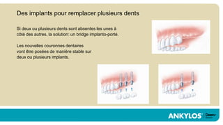 Des implants pour remplacer plusieurs dents

Si deux ou plusieurs dents sont absentes les unes à
côté des autres, la solution: un bridge implanto-porté.

Les nouvelles couronnes dentaires
vont être posées de manière stable sur
deux ou plusieurs implants.
 