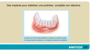 Des implants pour stabiliser une prothèse complète non rétentive
 