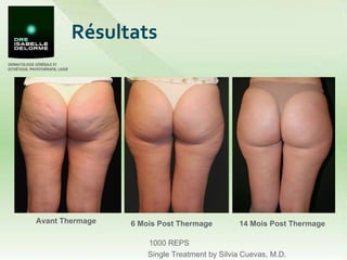 Résultats Avant Thermage  Single Treatment by Silvia Cuevas, M.D. 1000 REPS 6 Mois Post Thermage 14 Mois Post Thermage 