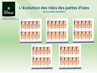 L’évolution des rides des pattes d’oies  (Source: Merz Aesthetic) Grade 0 Grade 2 Grade 1 Grade 4 Grade 3 