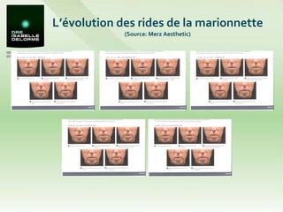 L’évolution des rides de la marionnette  (Source: Merz Aesthetic) Grade 0 Grade 2 Grade 1 Grade 4 Grade 3 