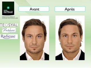 Avant Après 