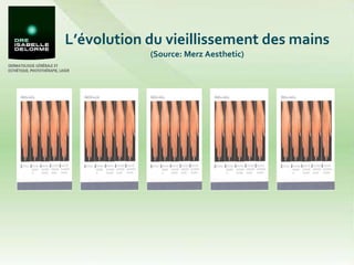 L’évolution du vieillissement des mains  (Source: Merz Aesthetic) Grade 0 Grade 2 Grade 1 Grade 4 Grade 3 
