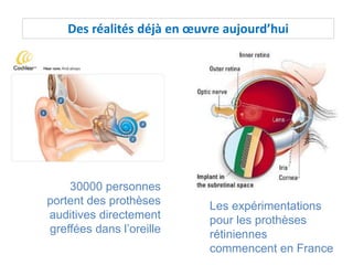 Des réalités déjà en œuvre aujourd’hui
30000 personnes
portent des prothèses
auditives directement
greffées dans l’oreille
Les expérimentations
pour les prothèses
rétiniennes
commencent en France
 