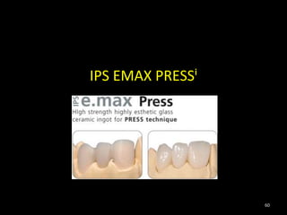 IPS EMAX PRESSⁱ
60
 