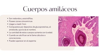 Cuerpos amiláceos
Son redondos y eosinófilos.
Poseen zonas cóncentricas
Llegan a medir 1mm
Compuestos por depositos de glucoproteínas, el
amieloide, que le da el nombre.
La cantidad de estos cuerpos aumenta con la edad.
Cuando se calcifican se le llama cálculos o
concreciones.
Pueden aparecer en el esperma
 