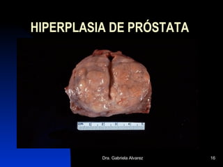 HIPERPLASIA DE PRÓSTATA 