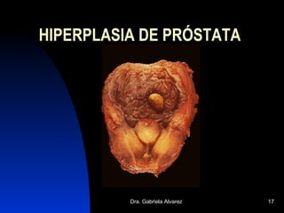 HIPERPLASIA DE PRÓSTATA 