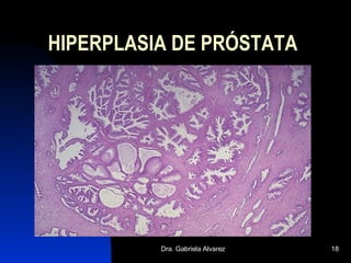 HIPERPLASIA DE PRÓSTATA 